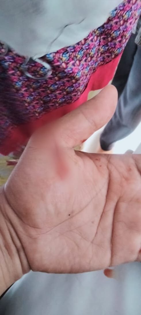 Personil Polsek Medan Timur Dibacok Preman Kampung