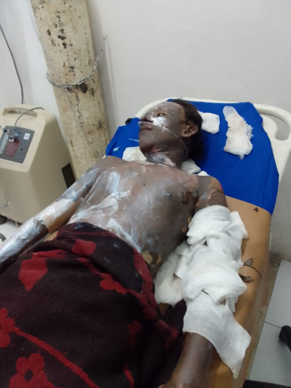 Deni Dibakarì Hidup – Hidup Akhirnya Tewas, Polisi Buru Dua Tersangka