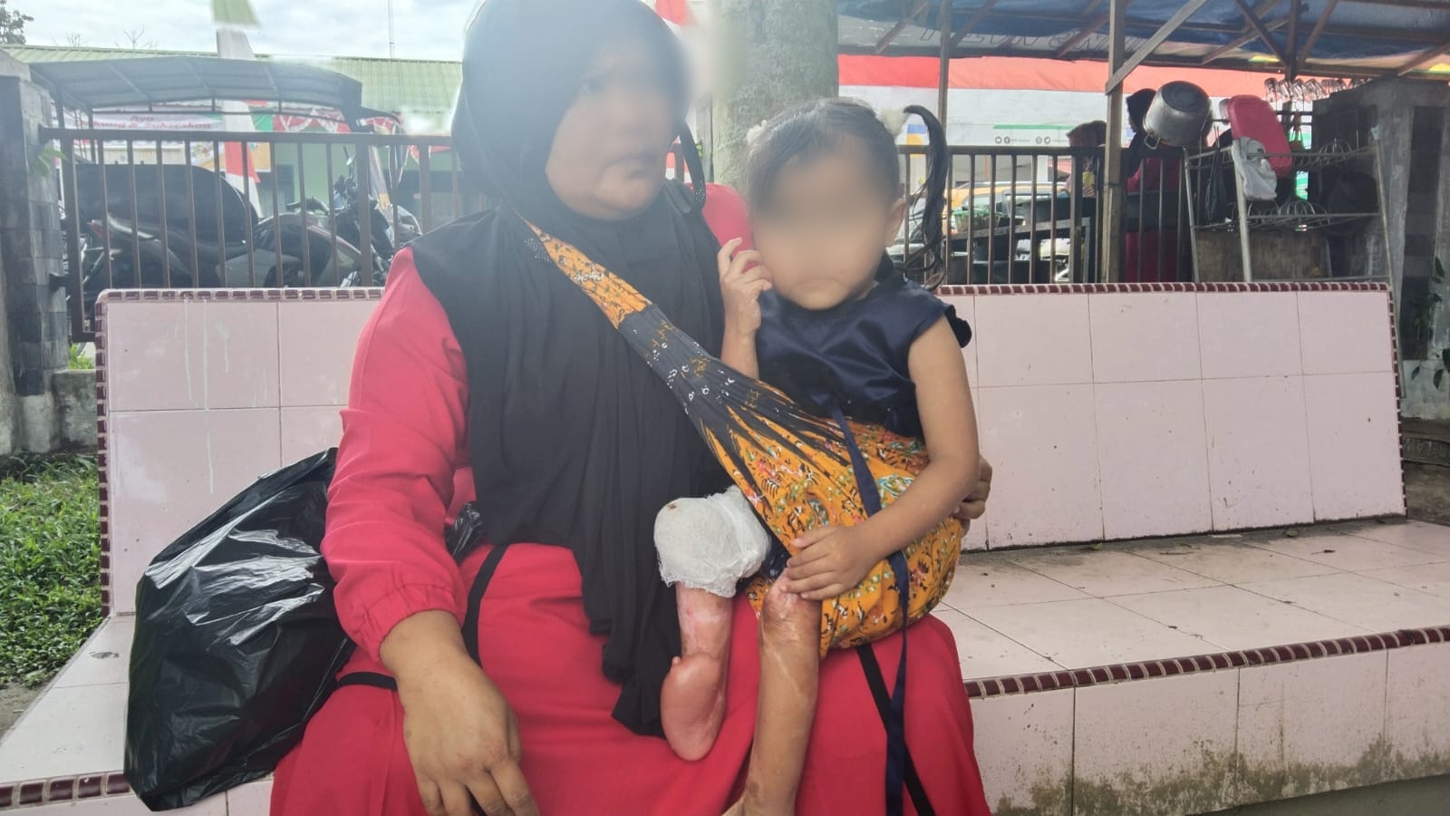 Bocah Asal Kotanopan Madina, Luka Bakar Kaki Lengket, Butuh Biaya Perobatan